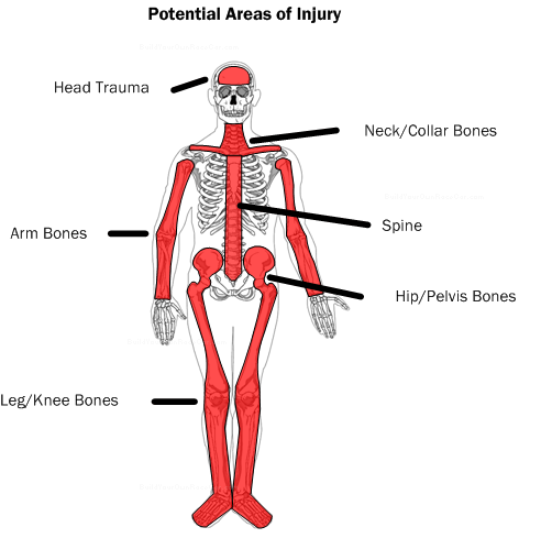 Diagram S1.  Potential areas of injury.  The design of the vehicle and the nature of the racing/driving environment largely determine the risk for different types of injuries.